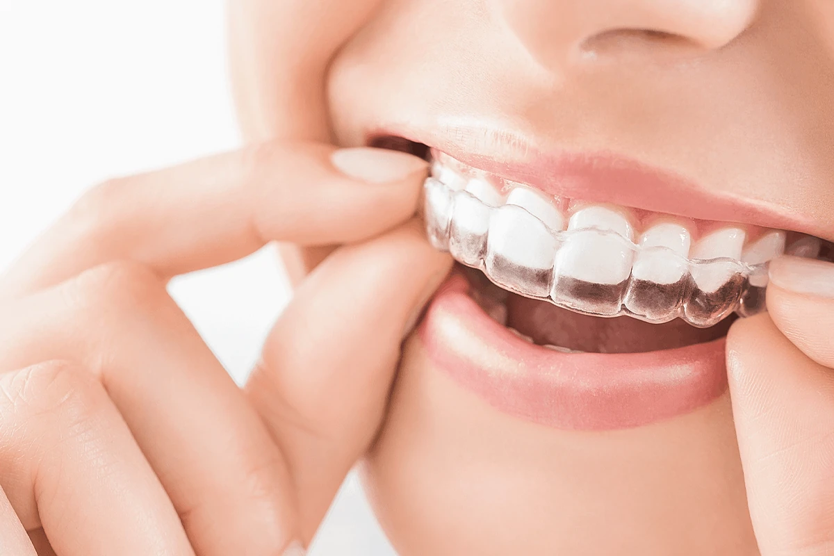 Aligner Aligner